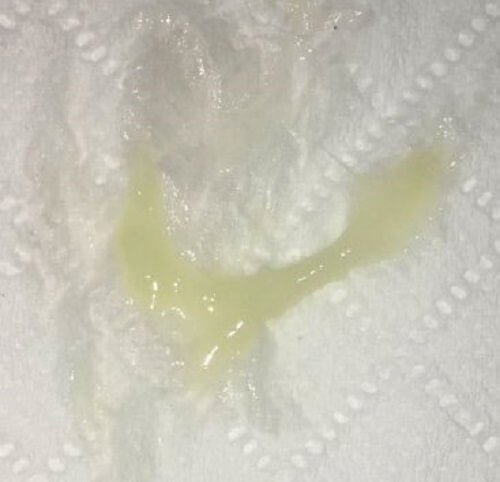 Khí hư đặc màu vàng xanh